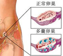 多囊卵巢与不孕症有“渊源”的关系！