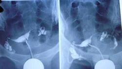 输卵管造影多少钱?选择东吴，让您不花冤枉钱