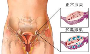多囊卵巢