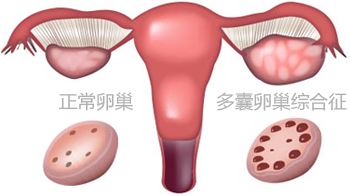 多囊卵巢
