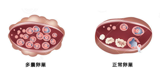 多囊卵巢
